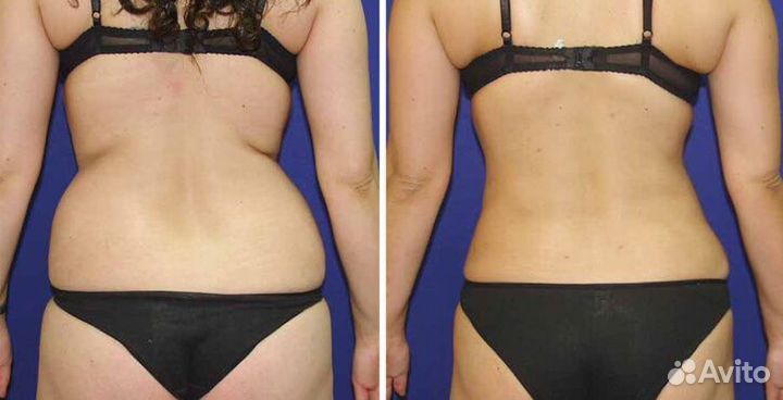 Криолиполиз, коррекция фигуры