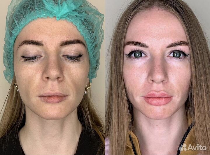 Lumecca фототерапия фотоомоложение