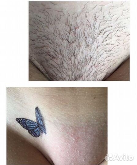 Шугаринг, Эпиляция