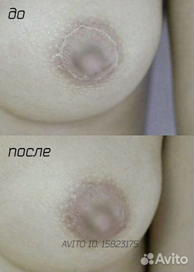 Удаление шрамов Камуфляж рубцов растяжек витилиго