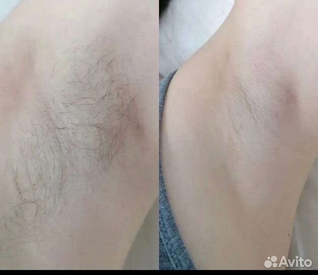 Депиляция/Шугаринг
