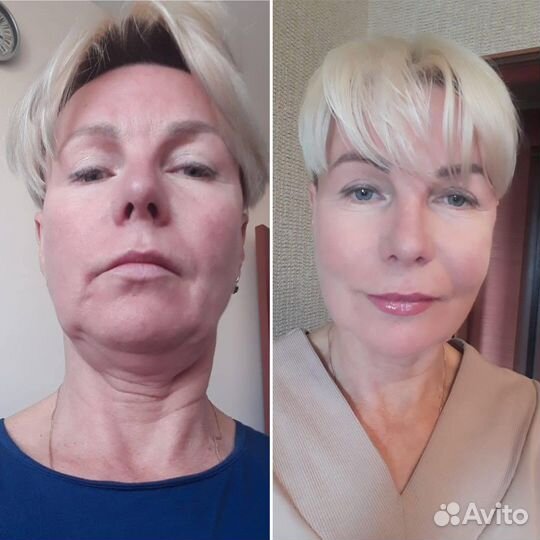 Подтяжка лица, брыли, мезонити, золотые нити