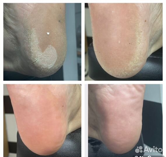 Педикюр,педуход с покрытием гельлак