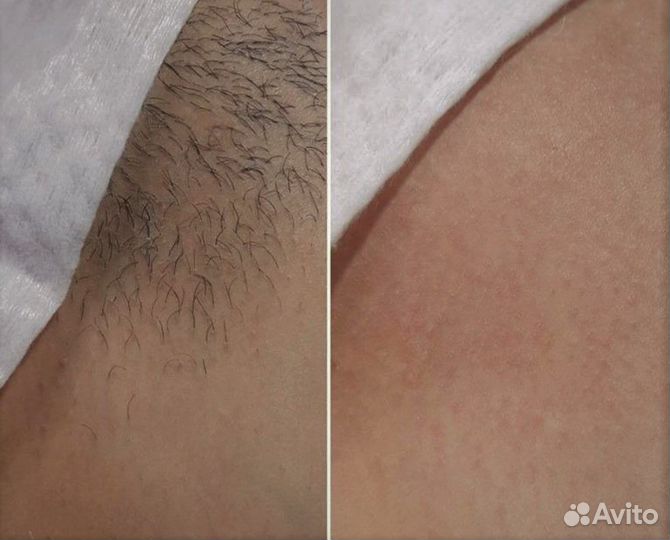 Лазерная эпиляция для девушек в студии