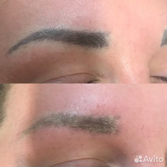 Удаления татуировок и татуажа