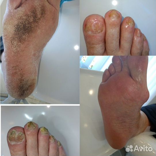 Педикюр от подолога