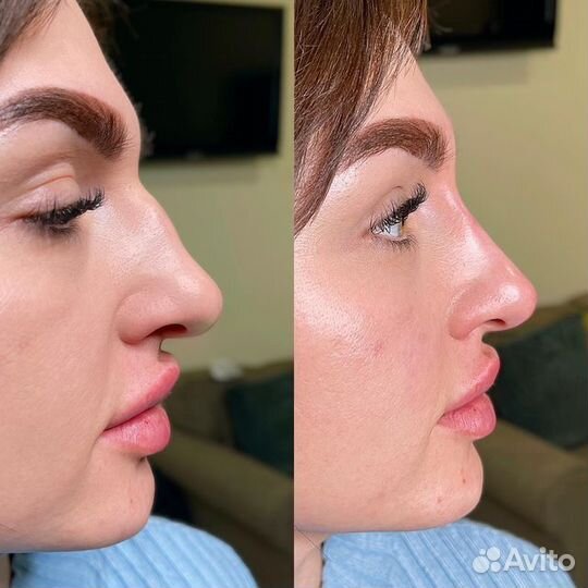 Ринопластика