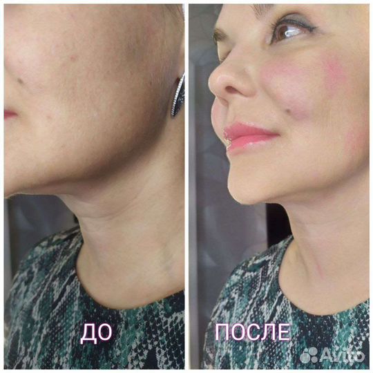 Смас-лифтинг (smas-лифтинг)
