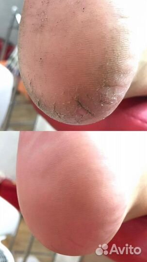 Услуги подолога / педикюр