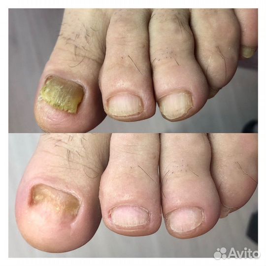 Лечебный педикюр