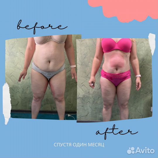 Криолиполиз услуги