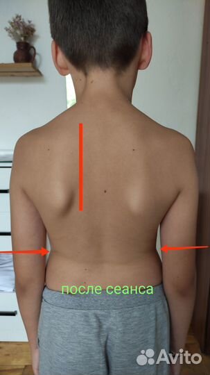 Лечение сколиоза и сопутствующих болезней