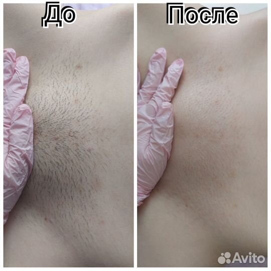 Восковая депиляция