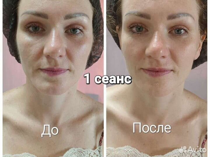 Массаж лица,Рф лифтинг лица.Микротоки