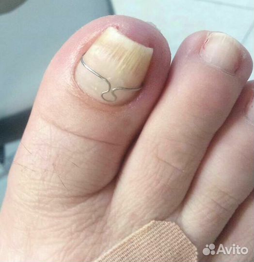 Коррекция ногтевой пластины (вросший ноготь)