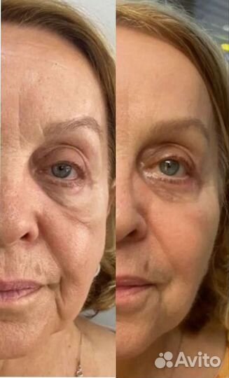 Массаж липопластика лица и тела