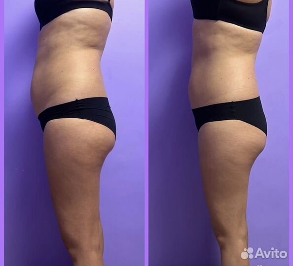 Вакуумный массаж,RF-лифтинг,кавитация,биофотон