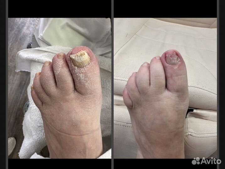 Лечебный педикюр подолог