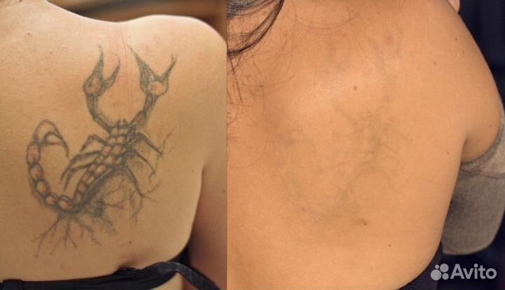 Удаление татуировок и татуажа. Карбоновый пилинг