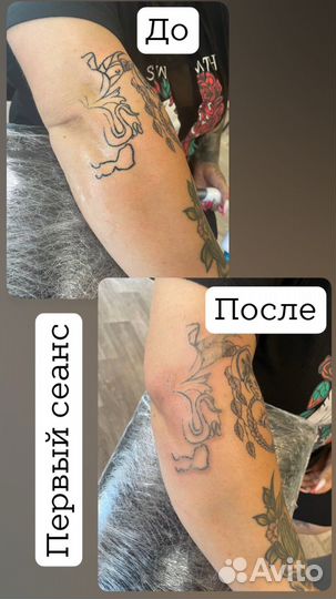 Тату, пм, Лазер