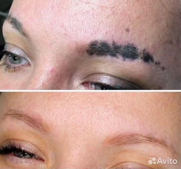 Лазерное удаление тату за одну процедуру*