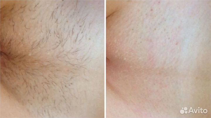 Модели / лазерная эпиляция / депиляция