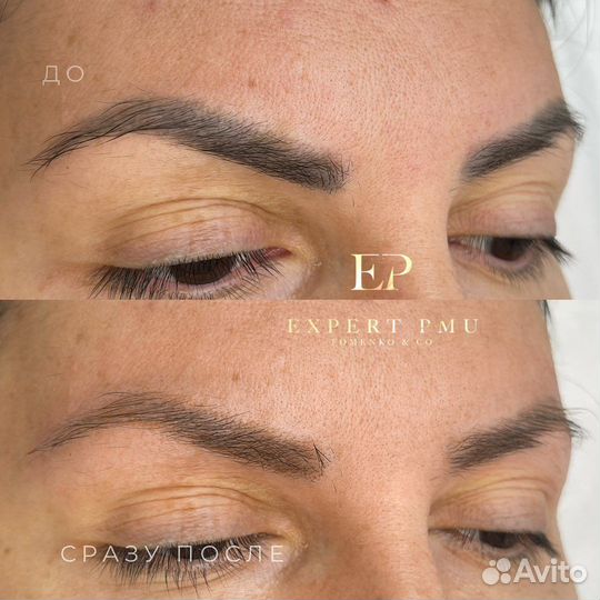 Лазер для удаления тату и татуажа Alpha+