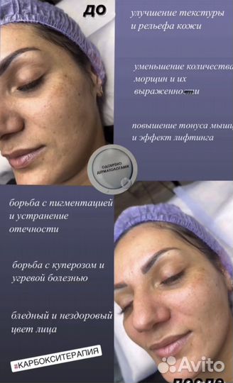 Карбокситерапия