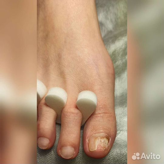 Подолог.Москва.Медицинский педикюр.Вросший ноготь