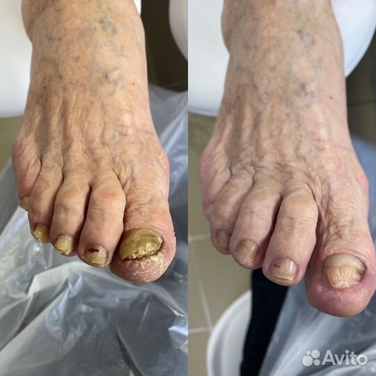 Лечебный педикюр подолог