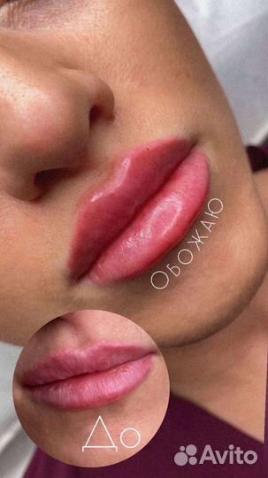 Инъекции ботокса в лоб