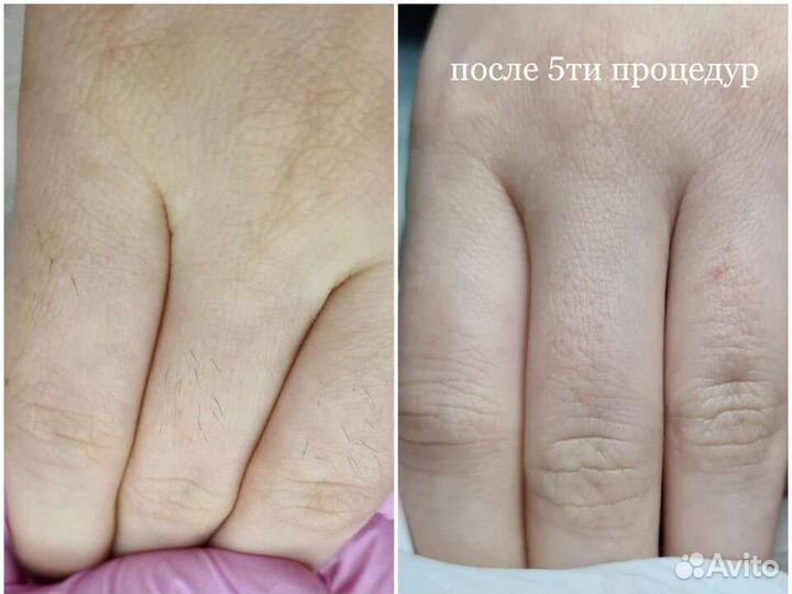 Электроэпиляция Нальчик