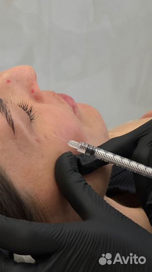 Ботокс лица