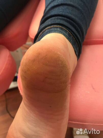 Аппаратный педикюр