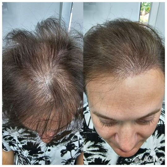 Трихопигментация головы