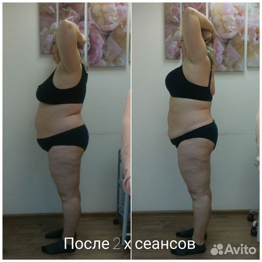 Висцеропластика и правки тела