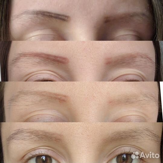 Удаление татуажа и тату лазером Lastik и ремувером