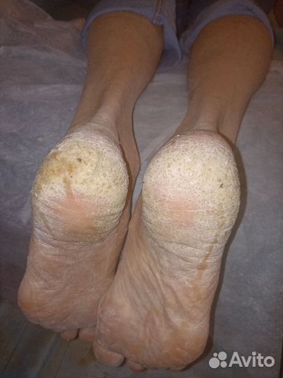 Медицинский педикюр на дому