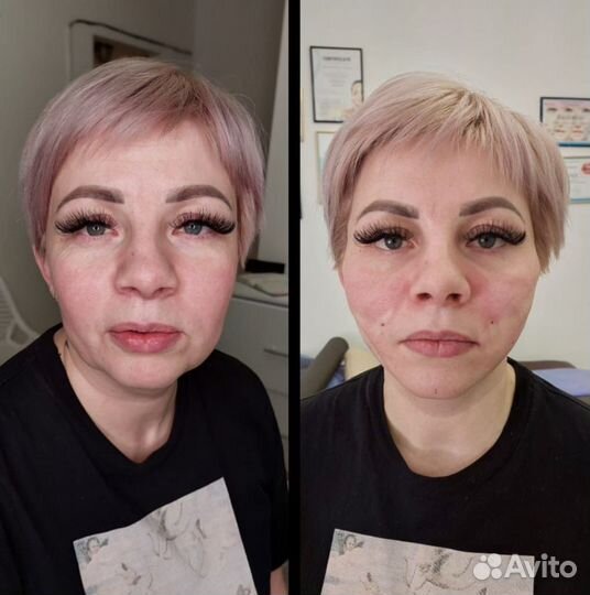 Подтяжка лица нитями ког мезонити моно