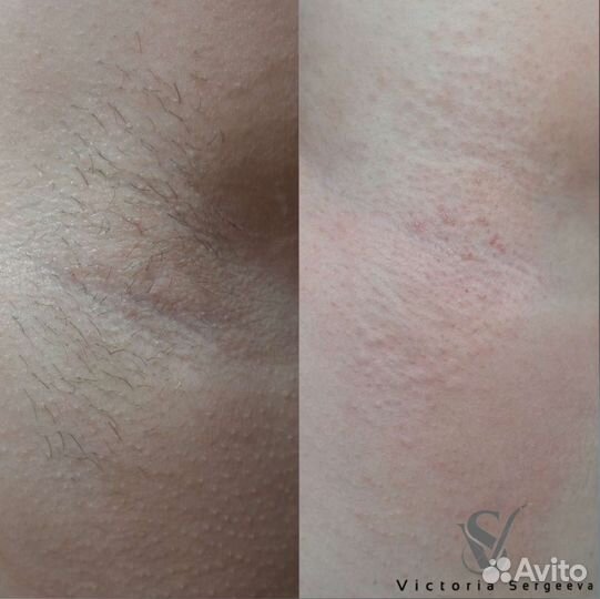 Электроэпиляция: подмышки