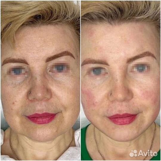 Мезоботокс, Коктейль Монако