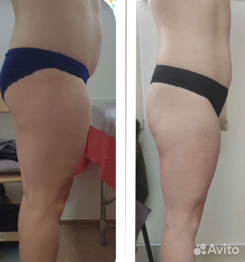 Антицеллюлитный массаж