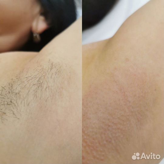 Депиляция - сахар/ воск. кмр