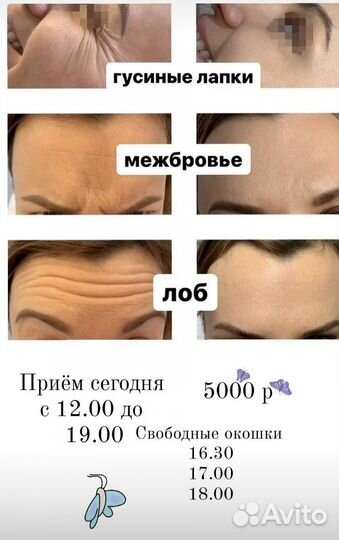 Ботокс для лица модель