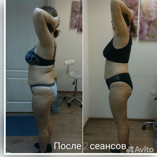 Висцеропластика и правки тела