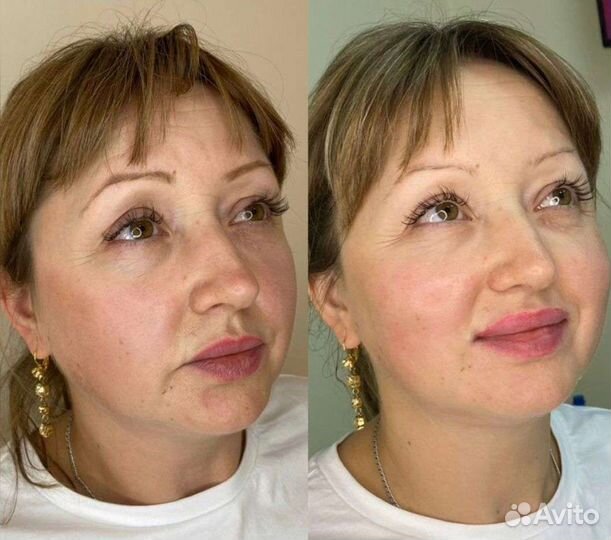 Смас лифтинг (smas лифтинг)