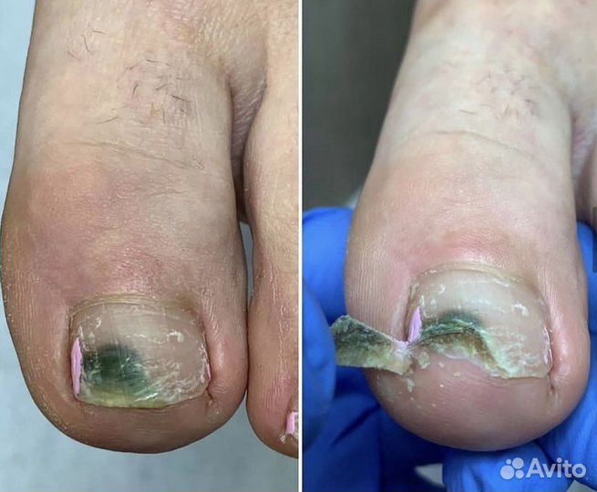 Медицинский педикюр подолог
