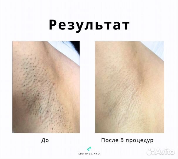 Диодный лазер для эпиляции Lumines Max’One 1200