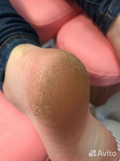 Аппаратный педикюр