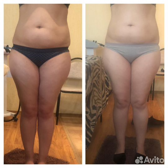 Процедура криолиполиз